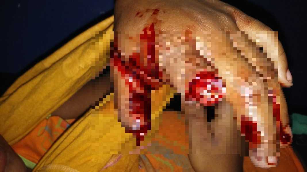 niña quemada en CHoluteca