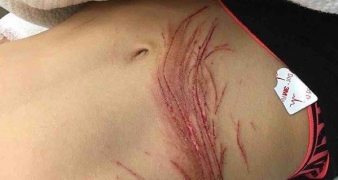 Parte de las heridas.