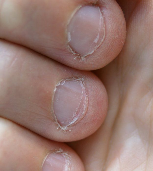 Murió porque se mordía las uñas