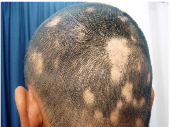 tratamiento de cabello en el HEU