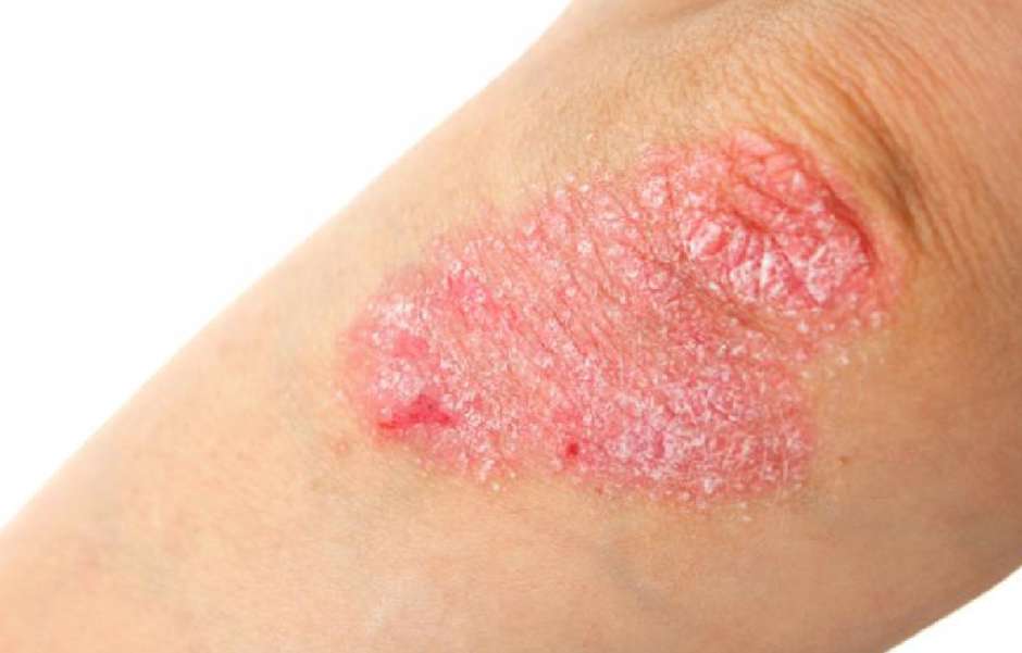 psoriasis