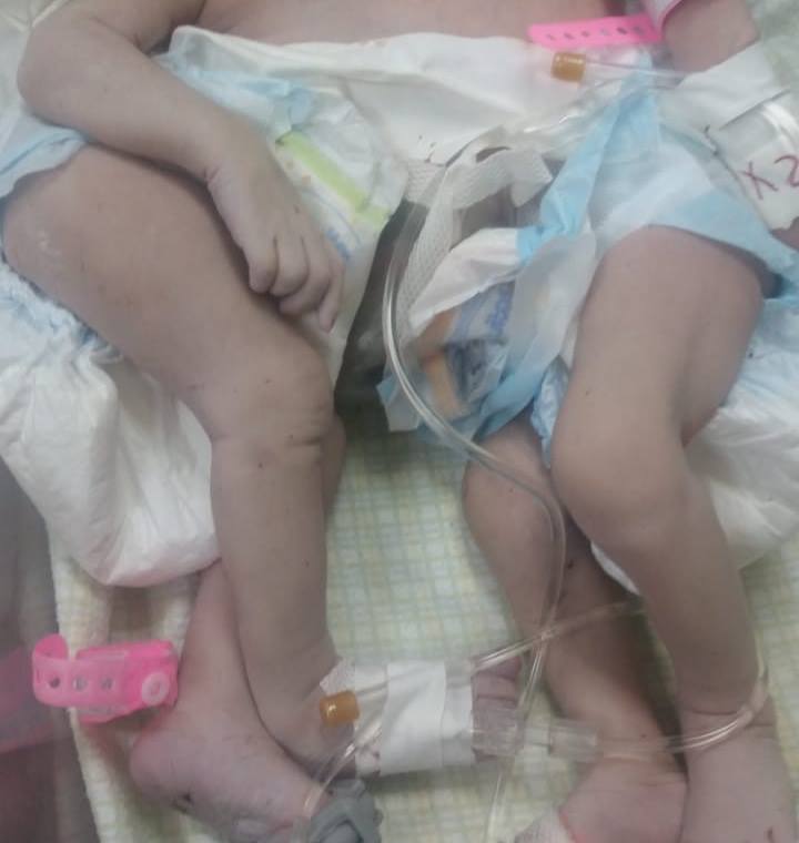 bebés siamesas