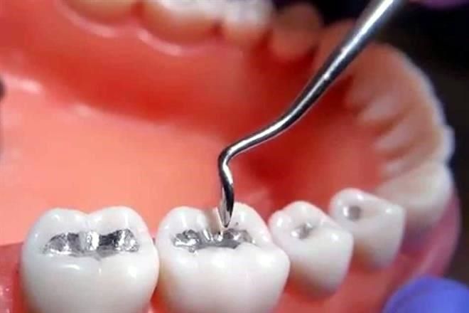 tapones dentales