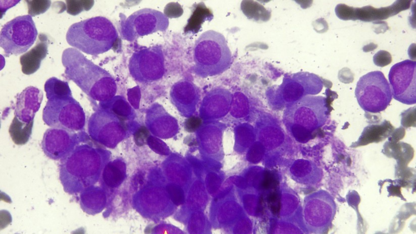 tumores cancerosos