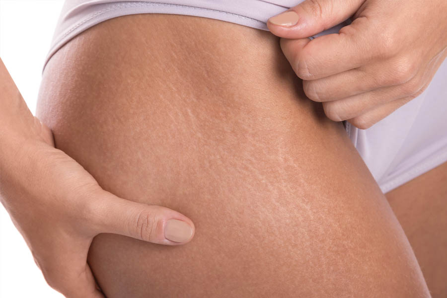 celulitis