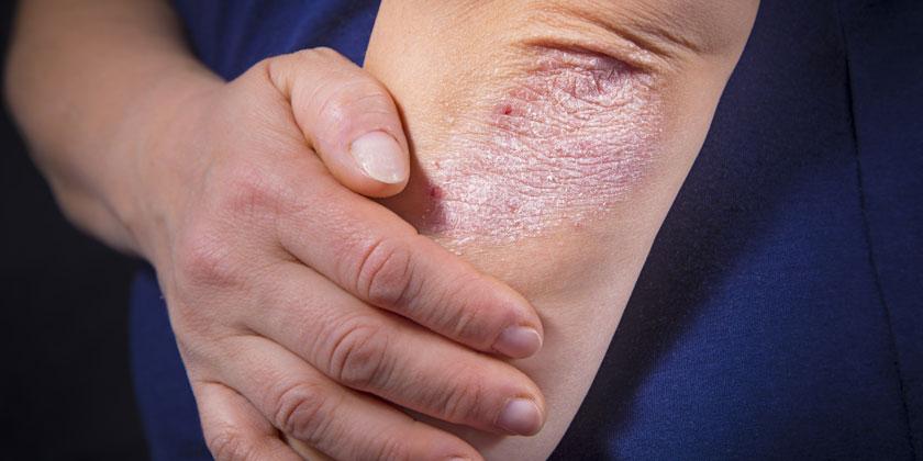 Psoriasis y artritis psoriásica