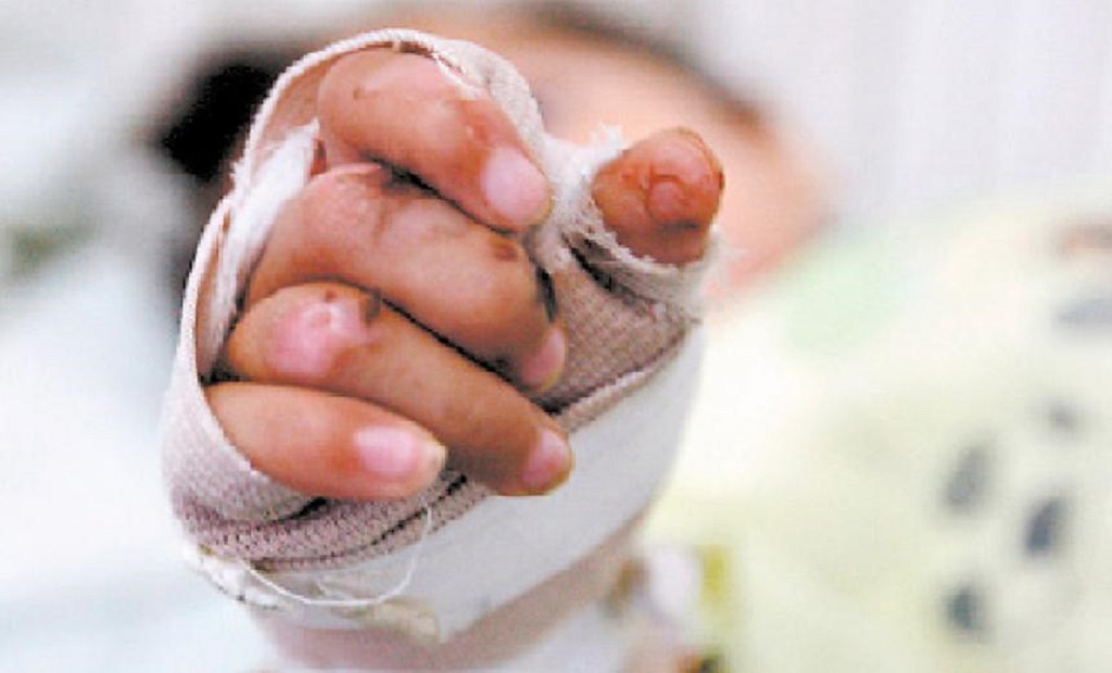 niño quemado fundaniquem cernada maíz
