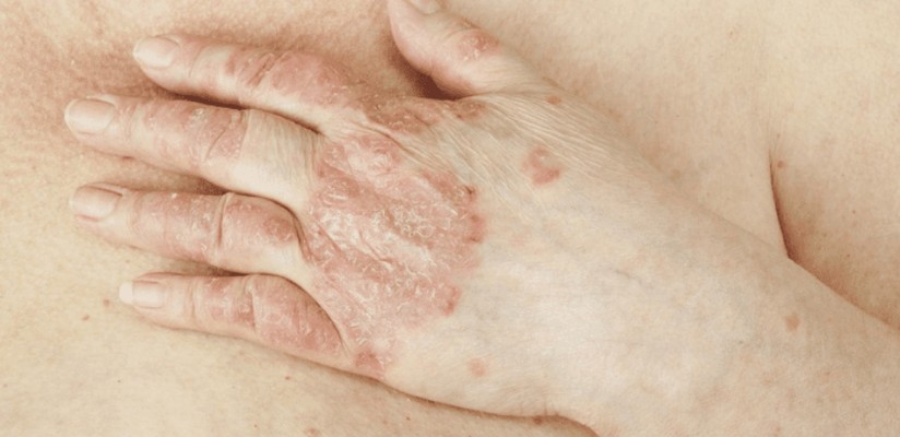 remedios caseros tratar psoriasis