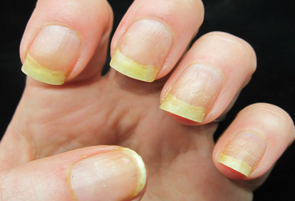 Uñas amarillas