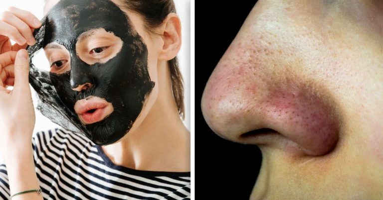 Tres mascarillas caseras para eliminar los puntos negros del rostro