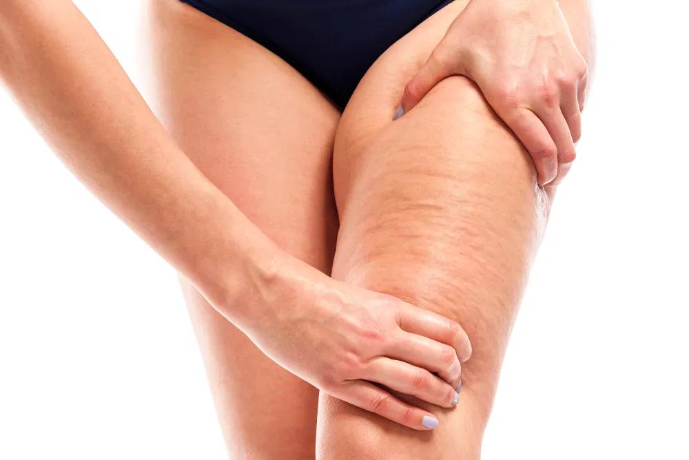 Tratamientos para eliminar la celulitis y la grasa de tu cuerpo