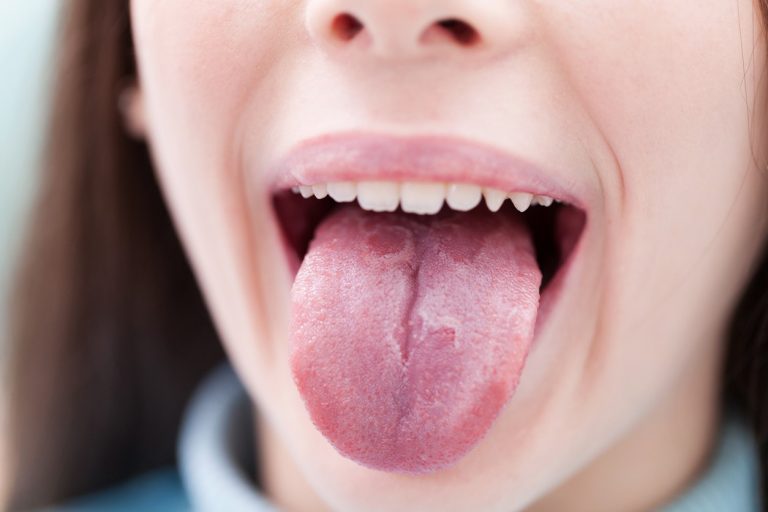 cáncer de lengua síntomas