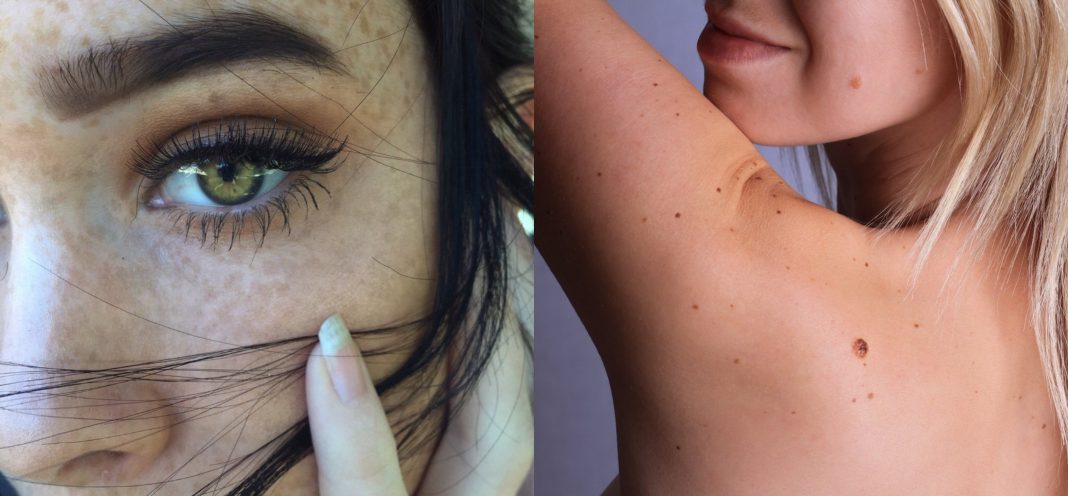 cuándo preocuparse pecas y lunares