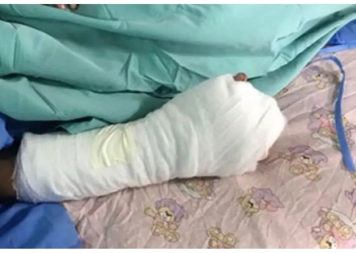 Primer niño quemado por pólvora