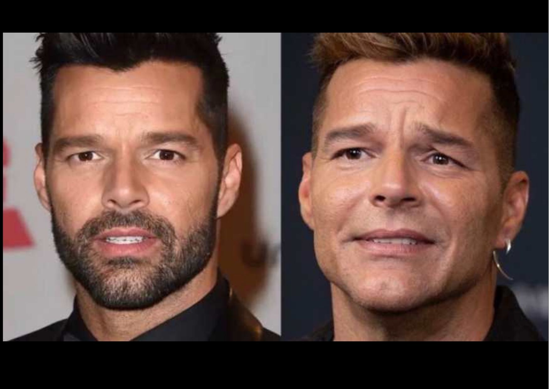 Famosos cirugías rostro