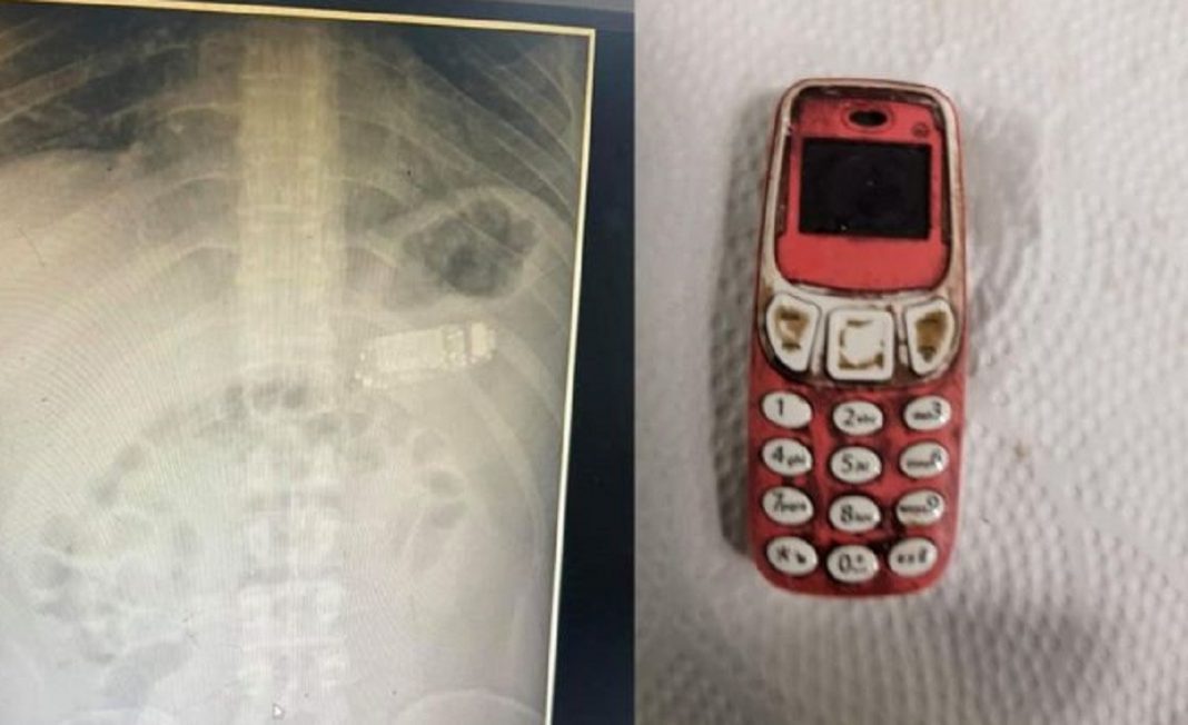 Extraen un teléfono del estomago.