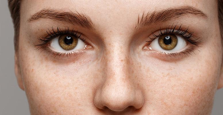 pecas y lunares malos