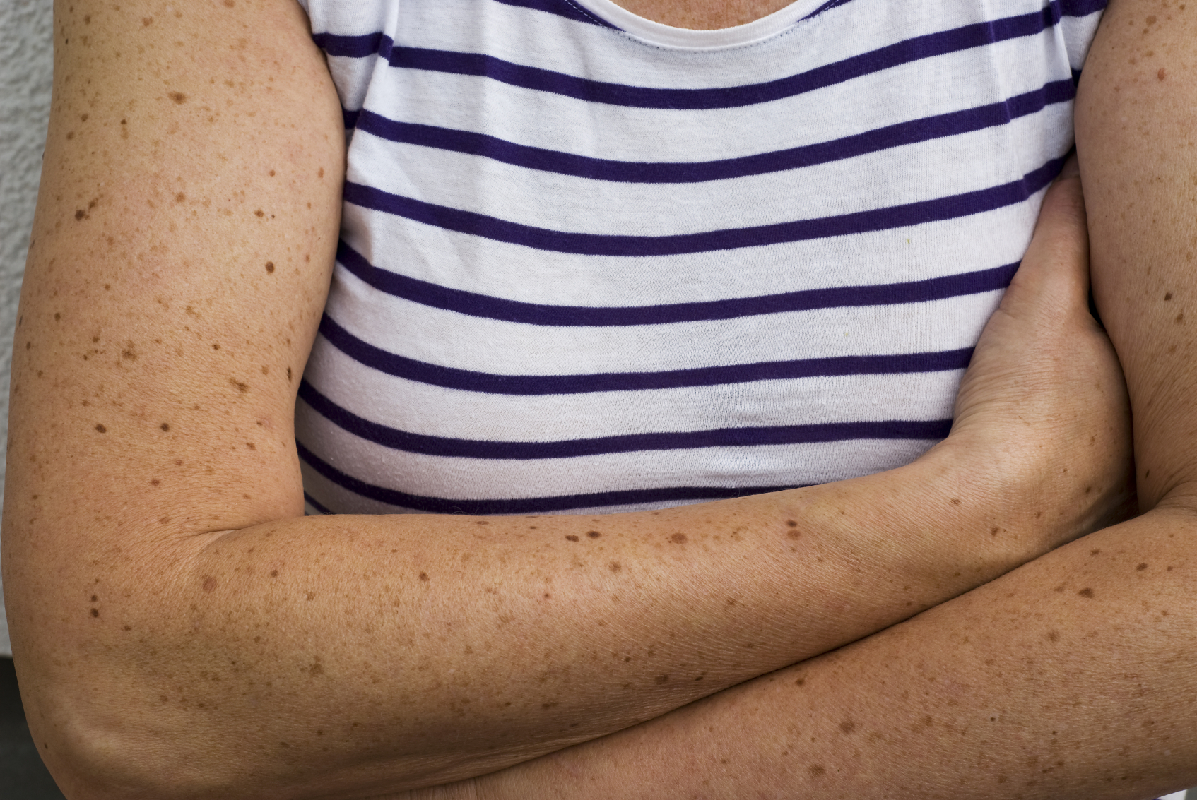 Para algunas personas las pecas pueden ser vergonzosas.