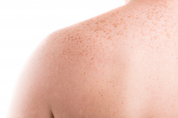 Las pecas pueden aparecer en diferentes partes del cuerpo.