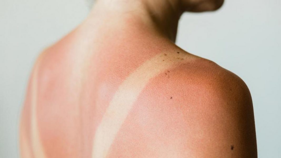 Cómo aclarar piel quemada por el Sol