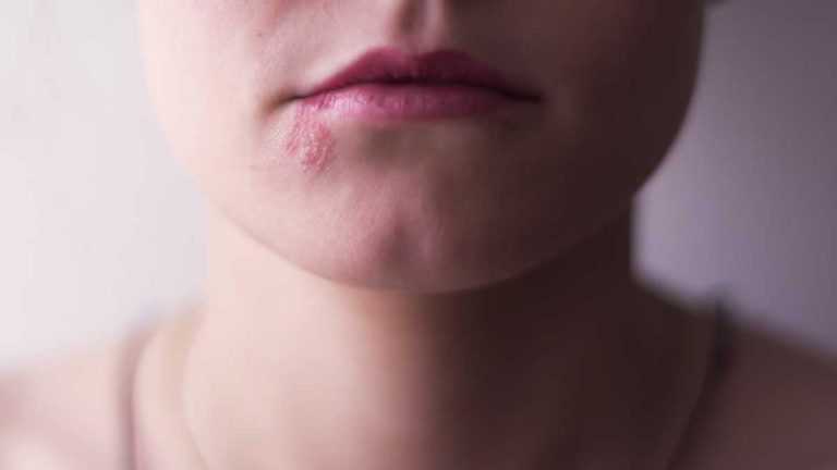 Herpes por estrés