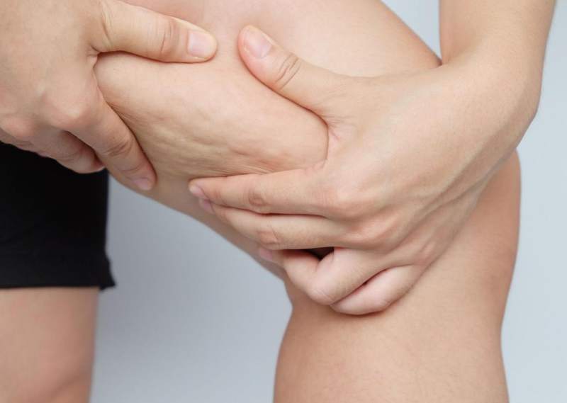 celulitis en las piernas