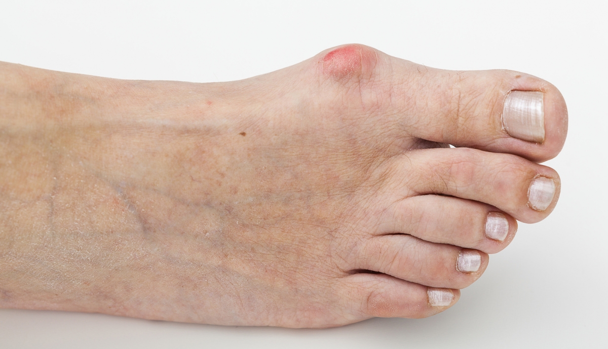 Se han presentado casos de juanetes debido a heridas en el pie, desórdenes neuromusculares, o deformidades congénitas.