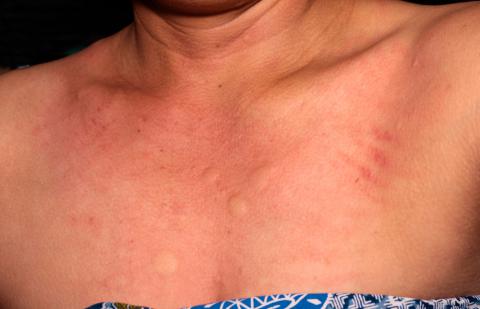 Alergia al perfume piel