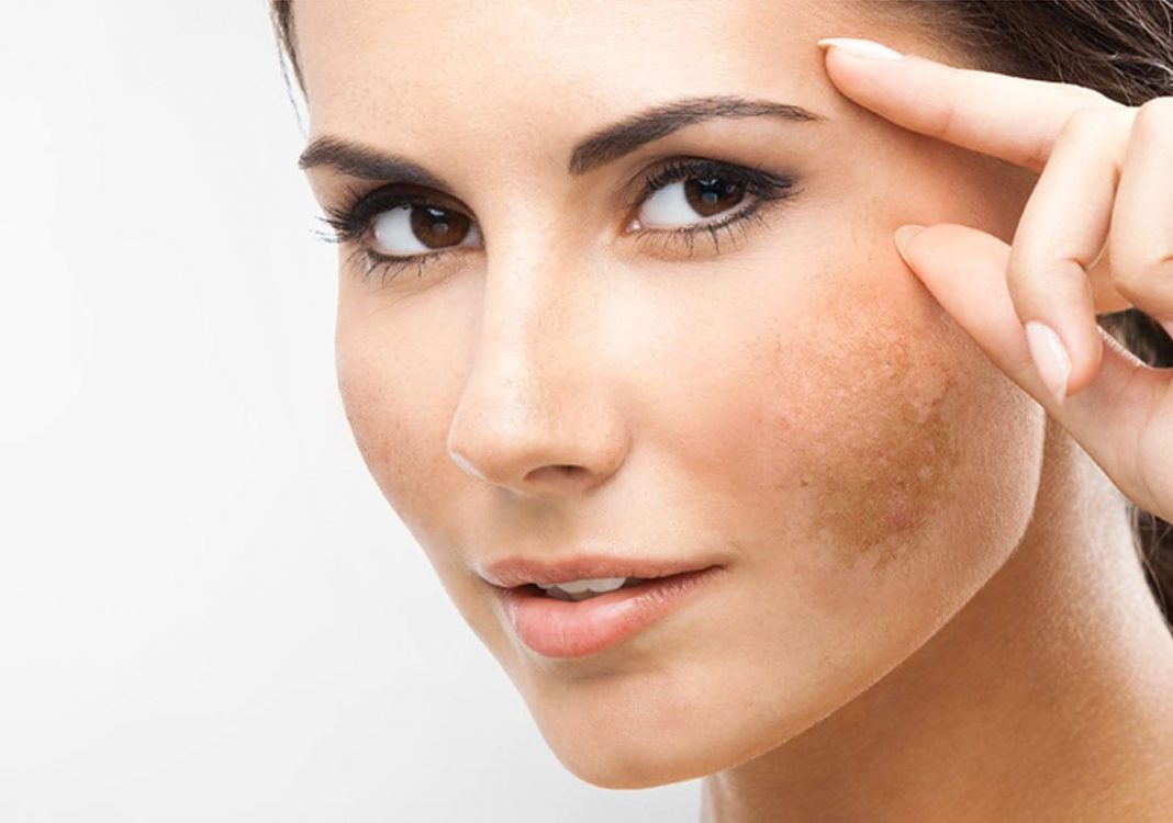 cremas para las manchas del rostro