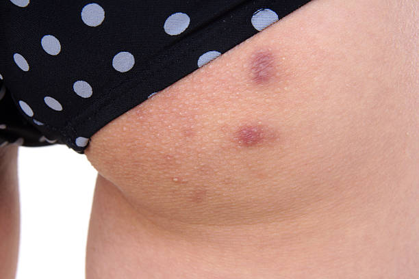 Otra de las causas más comunes de granos en las nalgas es una condición conocida como foliculitis. Se trata de una inflamación que se produce por la infección de bacterias, levaduras u hongos.