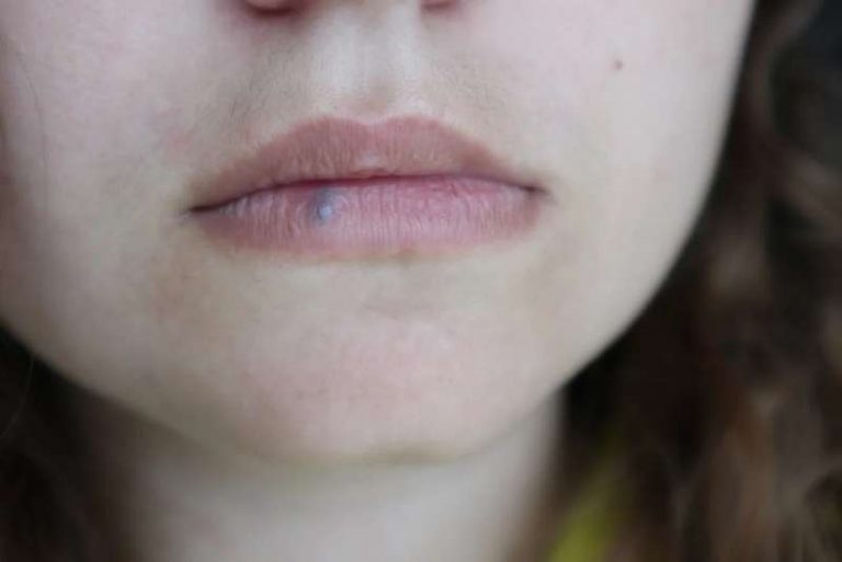 cáncer de labio síntomas