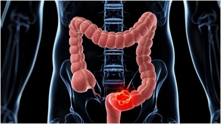 Productos light causan cáncer de colon
