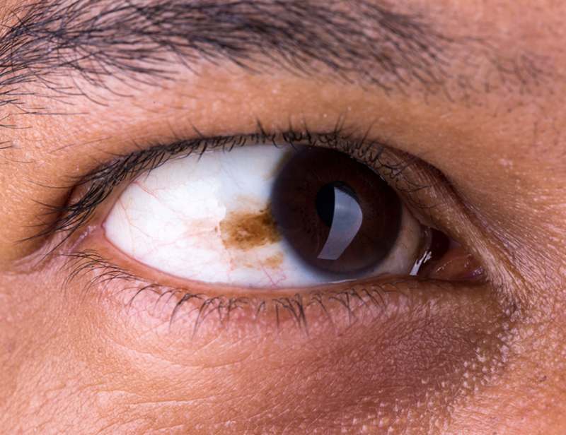 En muchos casos, el melanoma ocular transcurre sin síntomas. Por eso, con frecuencia se detecta a través de exámenes por la sospecha de un problema ocular.