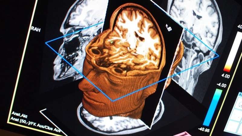 Escáner para detectar el Alzheimer