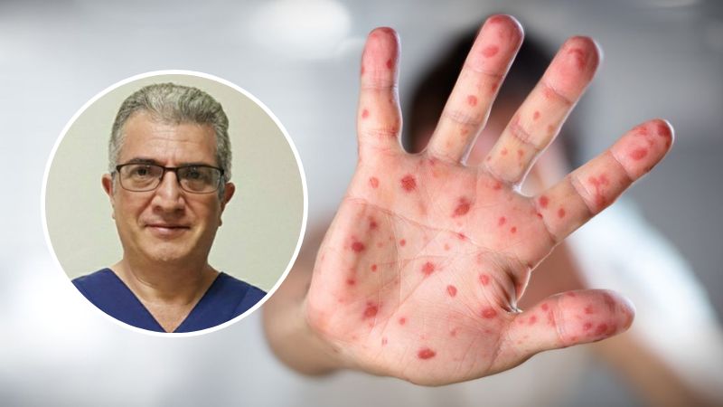 Genetista sobre viruela del mono
