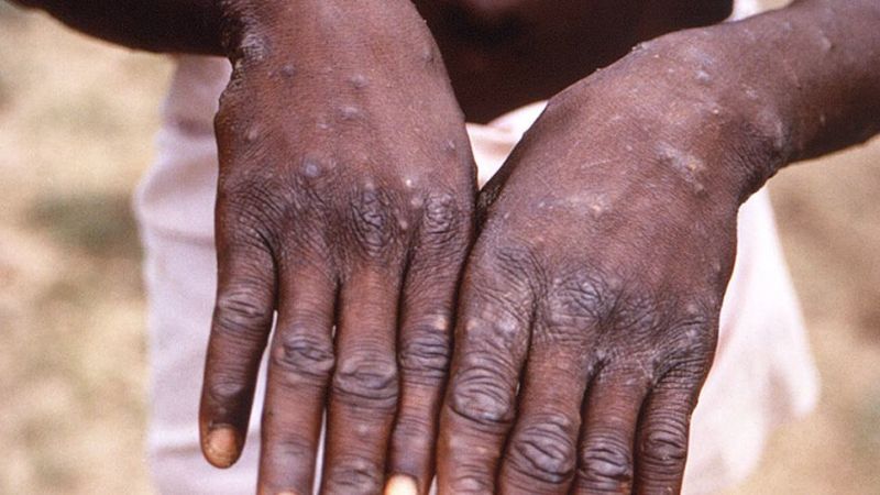 países con más casos de viruela del mono
