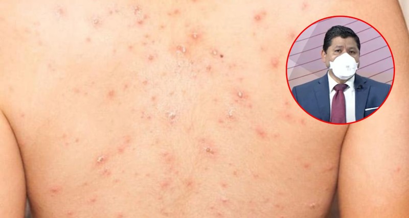 Extranjero contagio hondureño viruela
