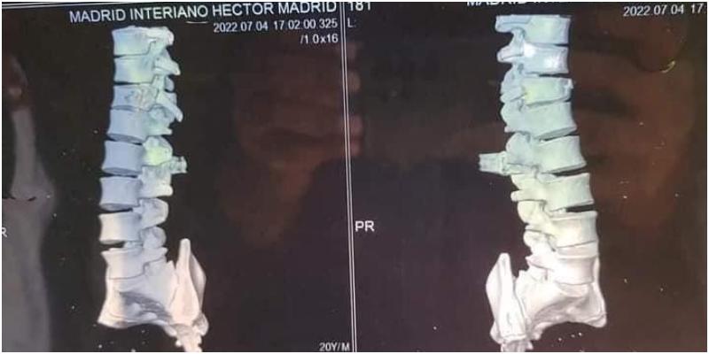 joven queda paralítico en Copán (2)