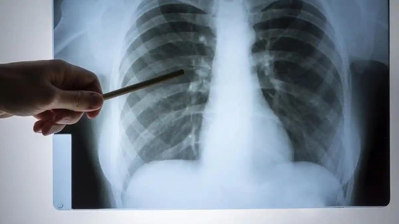 causas del dolor en el pecho