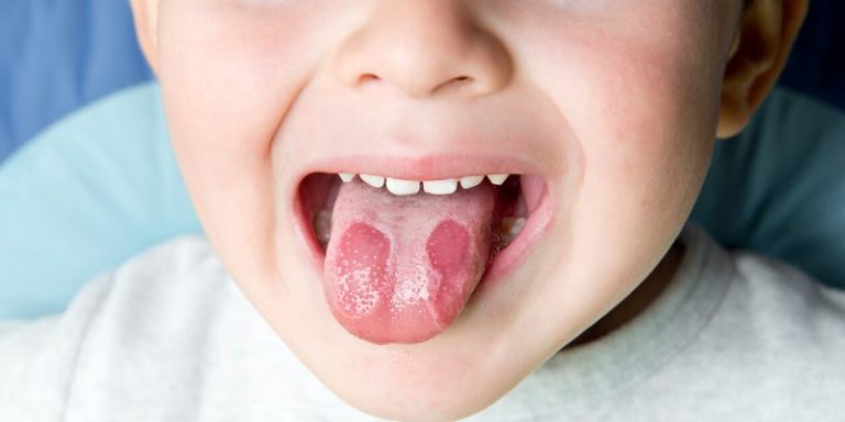 HONGOS EN LA LENGUA